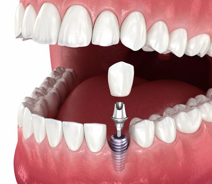 Implantes Dentales